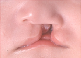 口唇口蓋裂術前写真